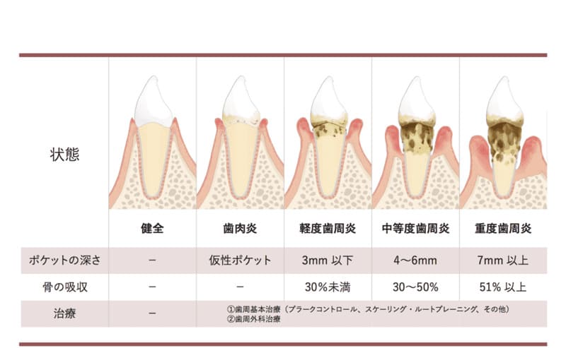 歯周病の進行と治療