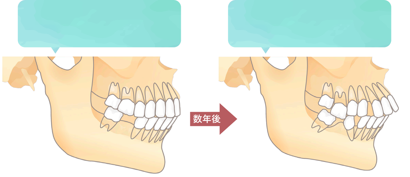 欠損歯の放置